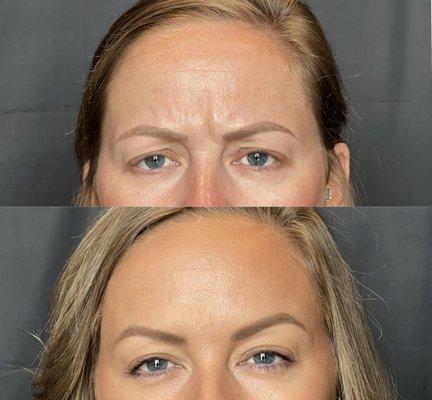 Botox- before and 2 weeks after