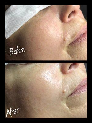 This treatment is the Ormedic Lift Peel!