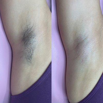 Underarm Wax