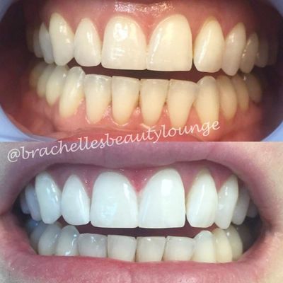 Teeth whitening