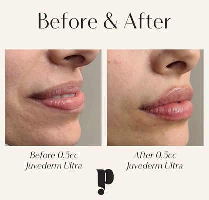 0.5cc of Lip Filler by Amber