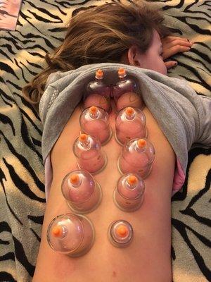 Cupping