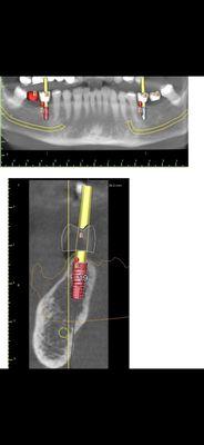 One of the world top specialist in 3D guided dental implant placement.