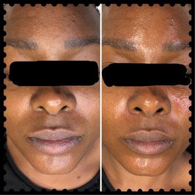 BioActive Peel (before/after)