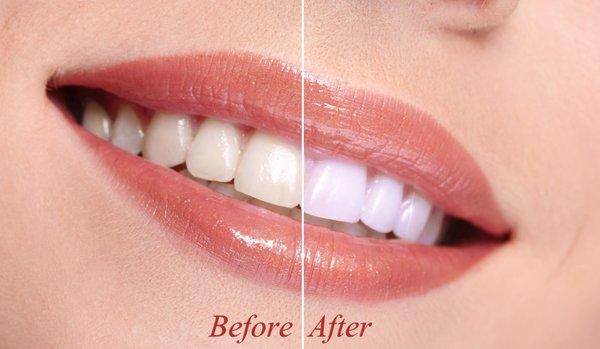 15 Minutes Teeth Whitening