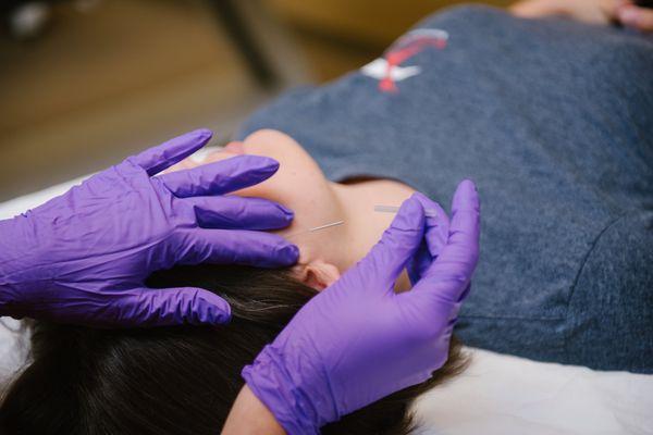 Dry Needling (www.stlpt.com/dry-needling)