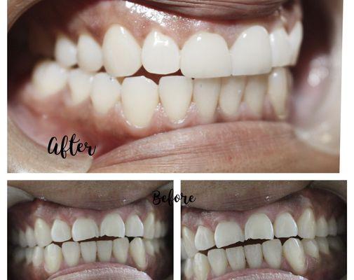 Nancy BEFORE and AFTER her All Porcelain Veneers. She is confident about her smile after many years!