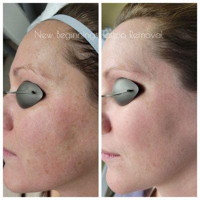 Fractional Co2 treatment for pigment removal.