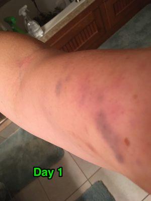 Day 1 - Burst blood vessel in Right arm