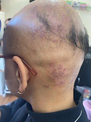 Our compassionate and skilled team is well-versed in providing specialized care for women experiencing alopecia.