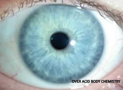 This person's body suffers from too much acid, turning a blue eye whitish