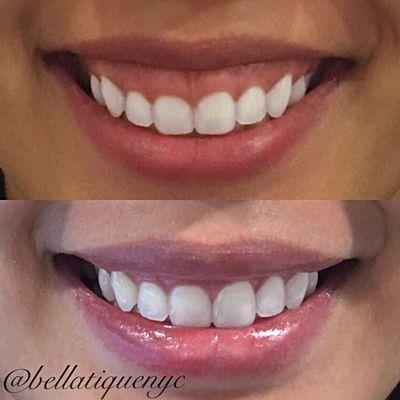 Gummy Smile Correction