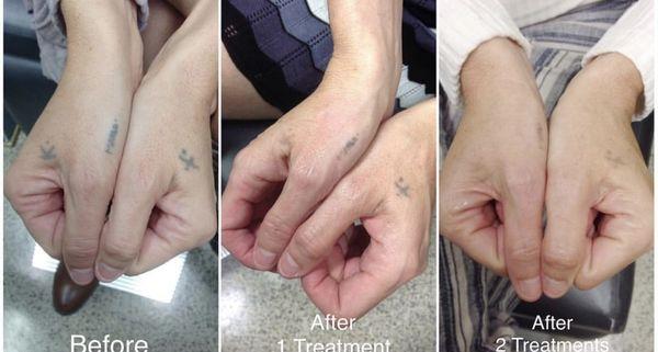 Tattoo removal