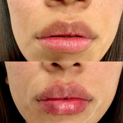 Lip filler before and after