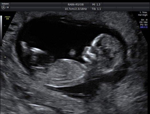 Gender ultrasound at 14 weeks