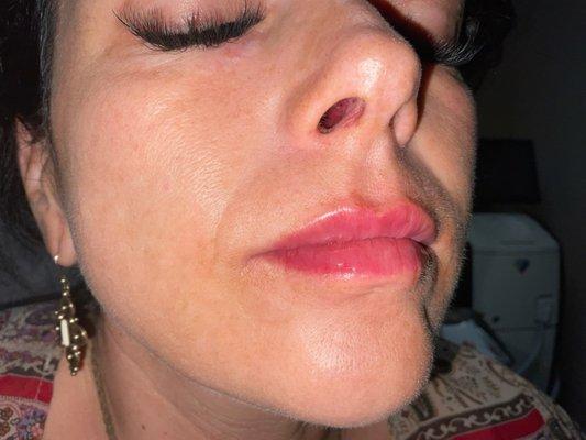 Lip filler juvederm