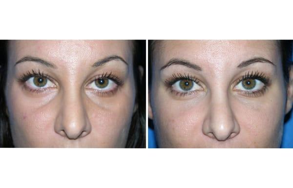 Undereye hollows improved with Restylane injections by Brian Reagan, M.D., FACS