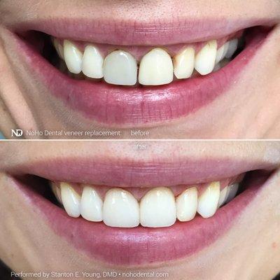 Dental veneer replacement performed by Dr. Young resolved this patient's aesthetic concern. Dental work needs artistry besides tech & craft.