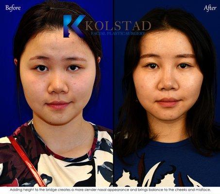 liquid rhinoplasty