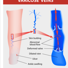 Varicose Vein