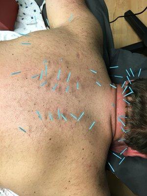 Dry needling for neck pain