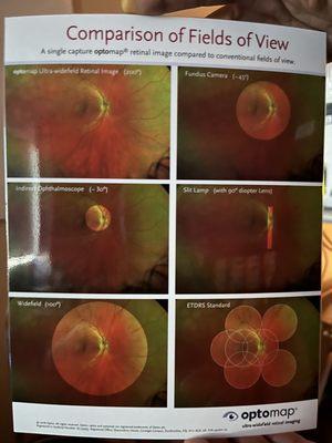 Comparing Dilation to the Optomap (what Dr. is able to see