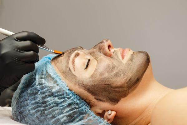 carbon laser peel