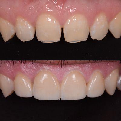 Four customized veneers by Dr Fung to revitalize some worn spaced teeth.