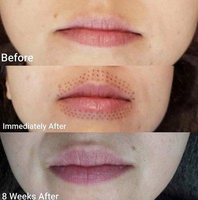 Plasma lip flip- lip enhancement