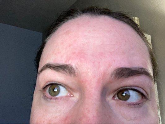 Skin rash by eyebrows