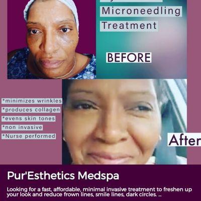 Thic client looks 10  years younger after Microneedling with Hyaluronic Serum