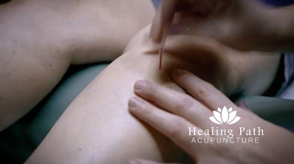 Acupunture