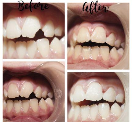 Kallie BEFORE and AFTER using resin composite bondings to make her smile perfect after a fall to the concrete.