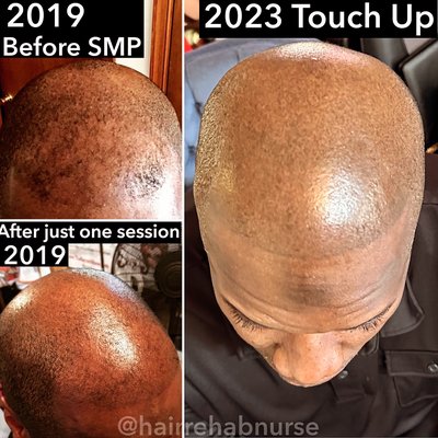 Scalp micro pigmentation on same client after 4 years!