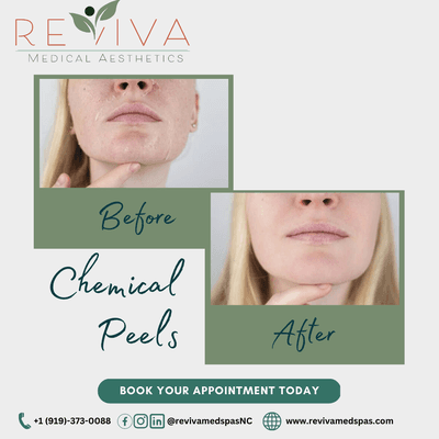 Nothing To Be Afraid Of With Chemical Peels! It involves applying a chemical solution to your skin and peeling off the dead skin.