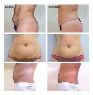 Make an appointment today for your cavi-lipo