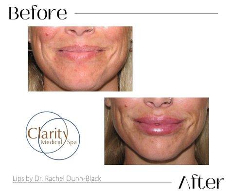 Dermal Filler on lips by Dr. Dunn-Black