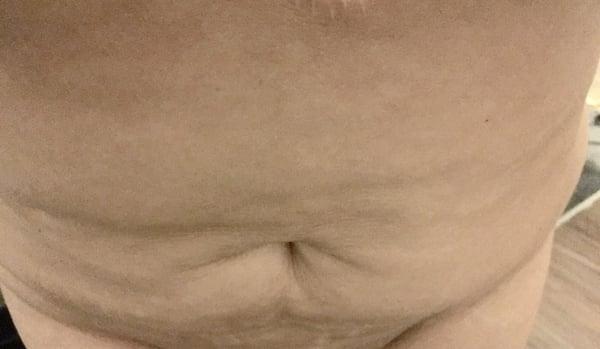 Approx 6 Huge welt like gauges in stomach area. Will need a Full tummy tuck now to correct (was told by another doctor)