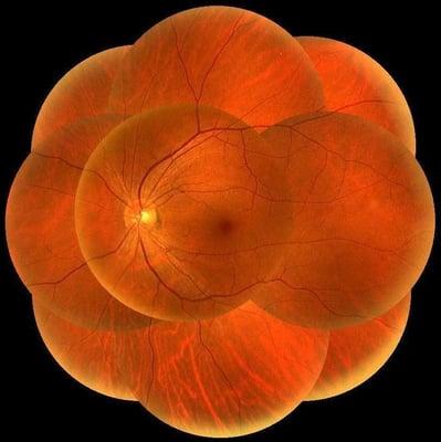 Picture of the back of an eye taken with our new DRS Retinal Camera