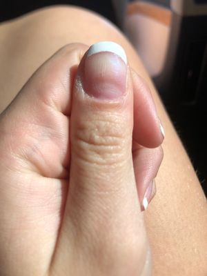 Giant scratch marks on my nail from the nail drill.