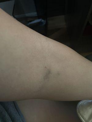 The arm where the vein was found- normal bruising.