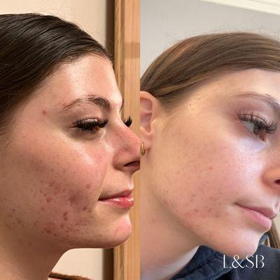 2 month Acne boot camp + treatment progress