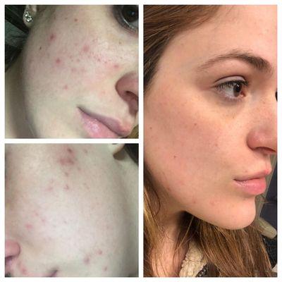 Several custom acne facials and microdermabrasion and microneedling helped clear her skin