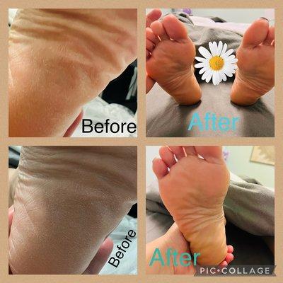 Before and after pictures of a therapeutic foot scrub/massage treatment.