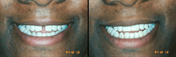 Cosmetic bonding to close gaps between front teeth.