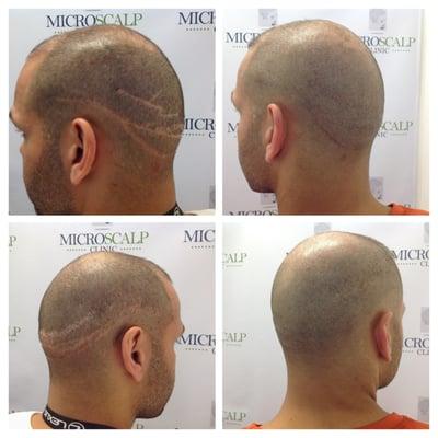 Micro Scalp Clinic Scar  http://www.microscalpclinic.com/