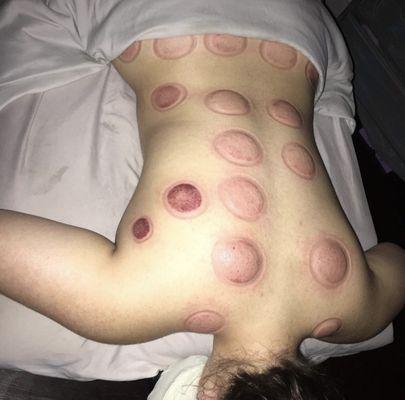 Cupping marks. 
"The darker the tissues the worse the issues."