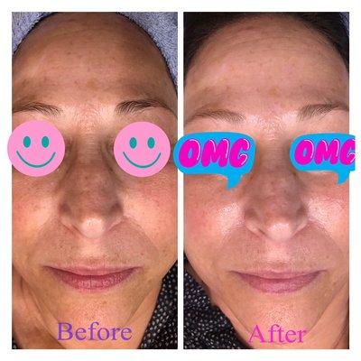 No filters needed with these great dermaplaning results.