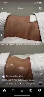 Post cosmetic surgery drainage massage