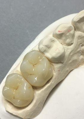 Emax ,lithium disilicate monolithic all ceramic posterior crowns.